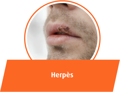 Herpès