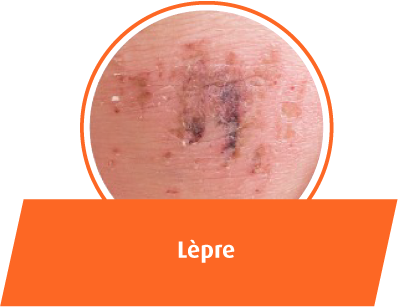 Lèpre