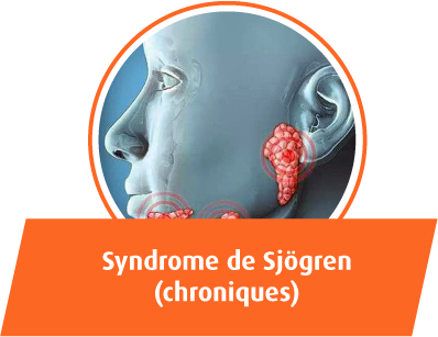 Syndrome de Sjogren