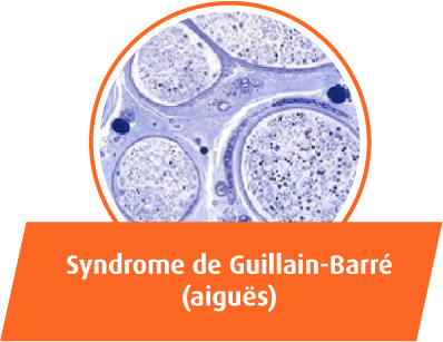 Syndrome Guillain Barré