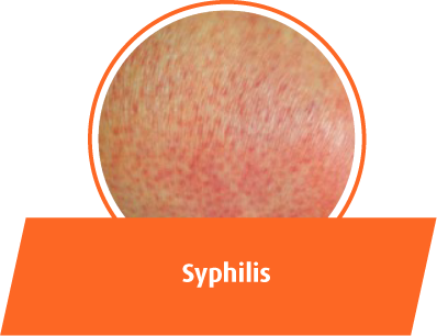 Syphilis