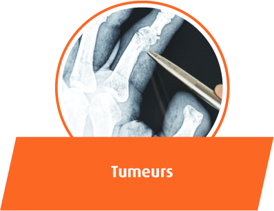 Tumeurs